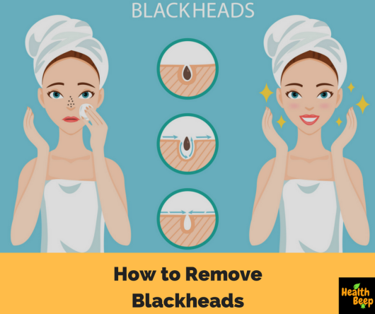 How to Remove Blackheads.png